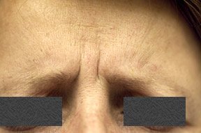 With botox decrease or erase wrinkles between the eyebrows